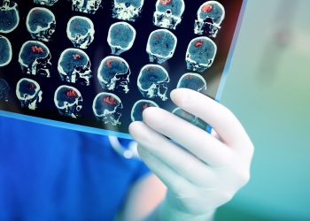 Accidentul vascular cerebral (AVC)