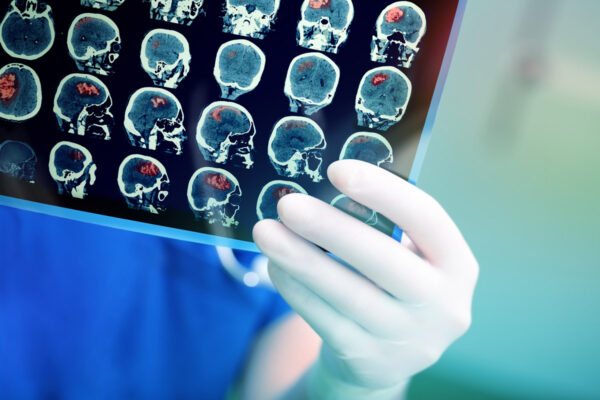 Accidentul vascular cerebral (AVC)