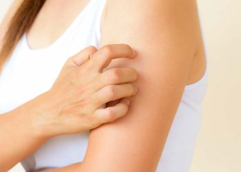 Urticaria