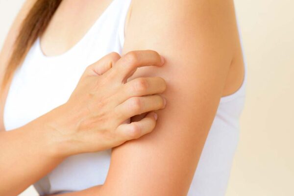 Urticaria